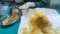 Bingöl`de bir hastanın safra kesesinden 2 Bin 67 taş çıkarıldı